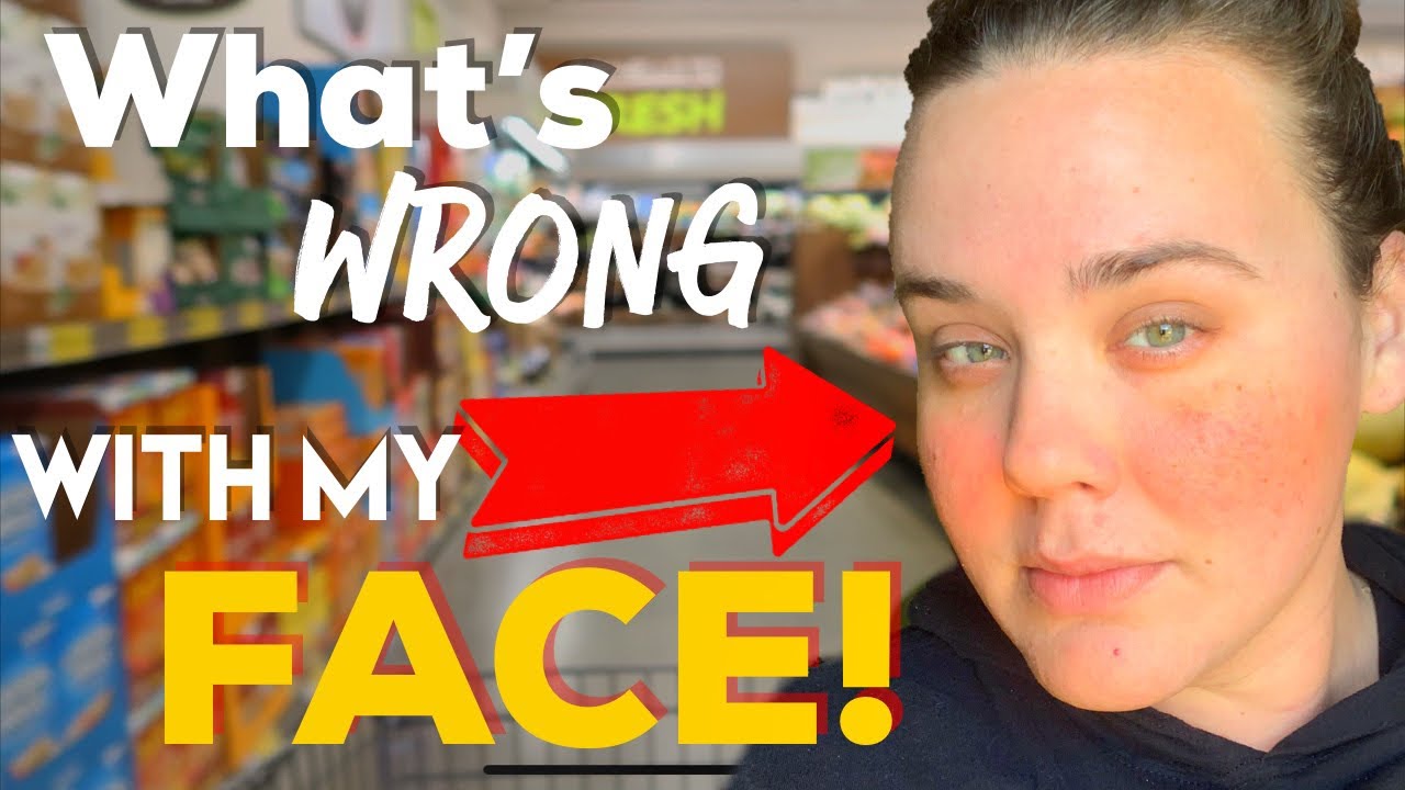 MY FIRST WEEK OF KETO | KETO RASH? KETO FLU? WEIGHTGAIN?
