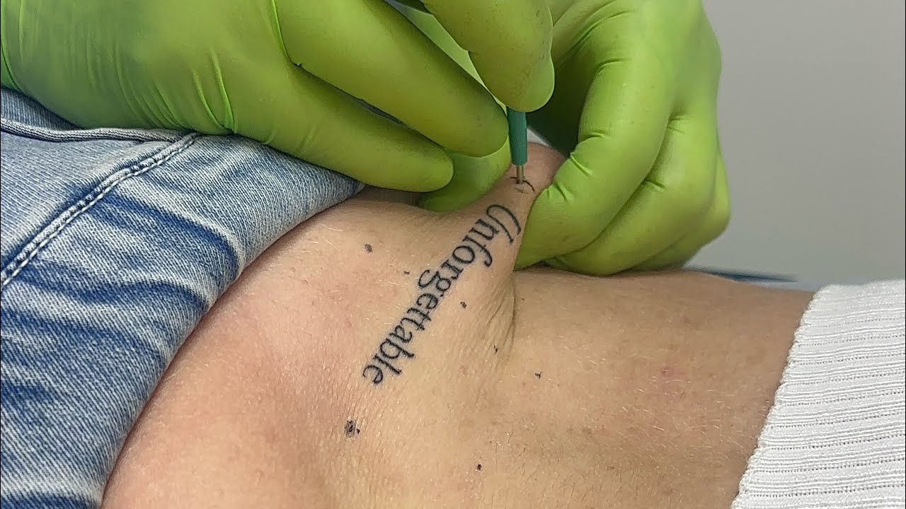 DIMPLE MICRODERMAL in the tattoo!