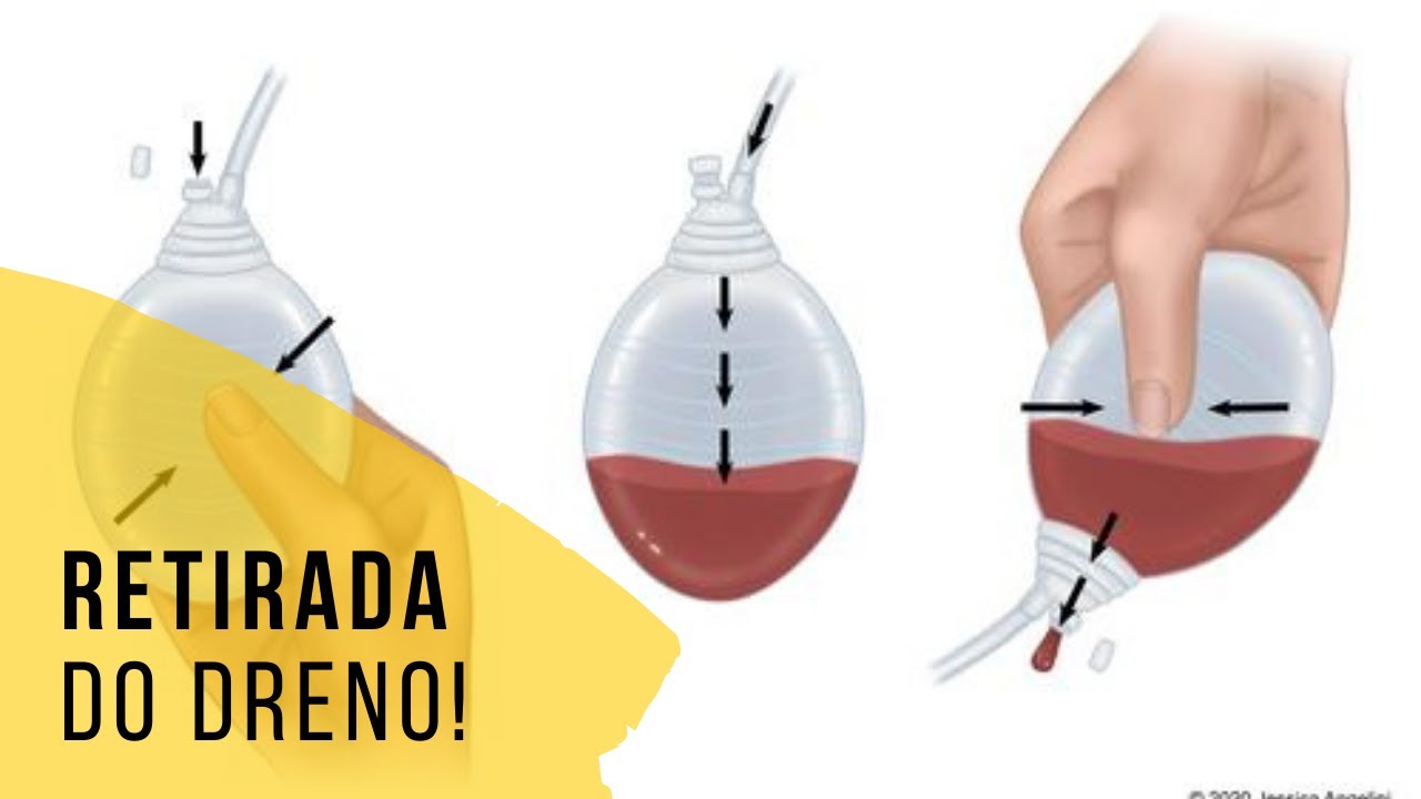 Como é a retirada do dreno?