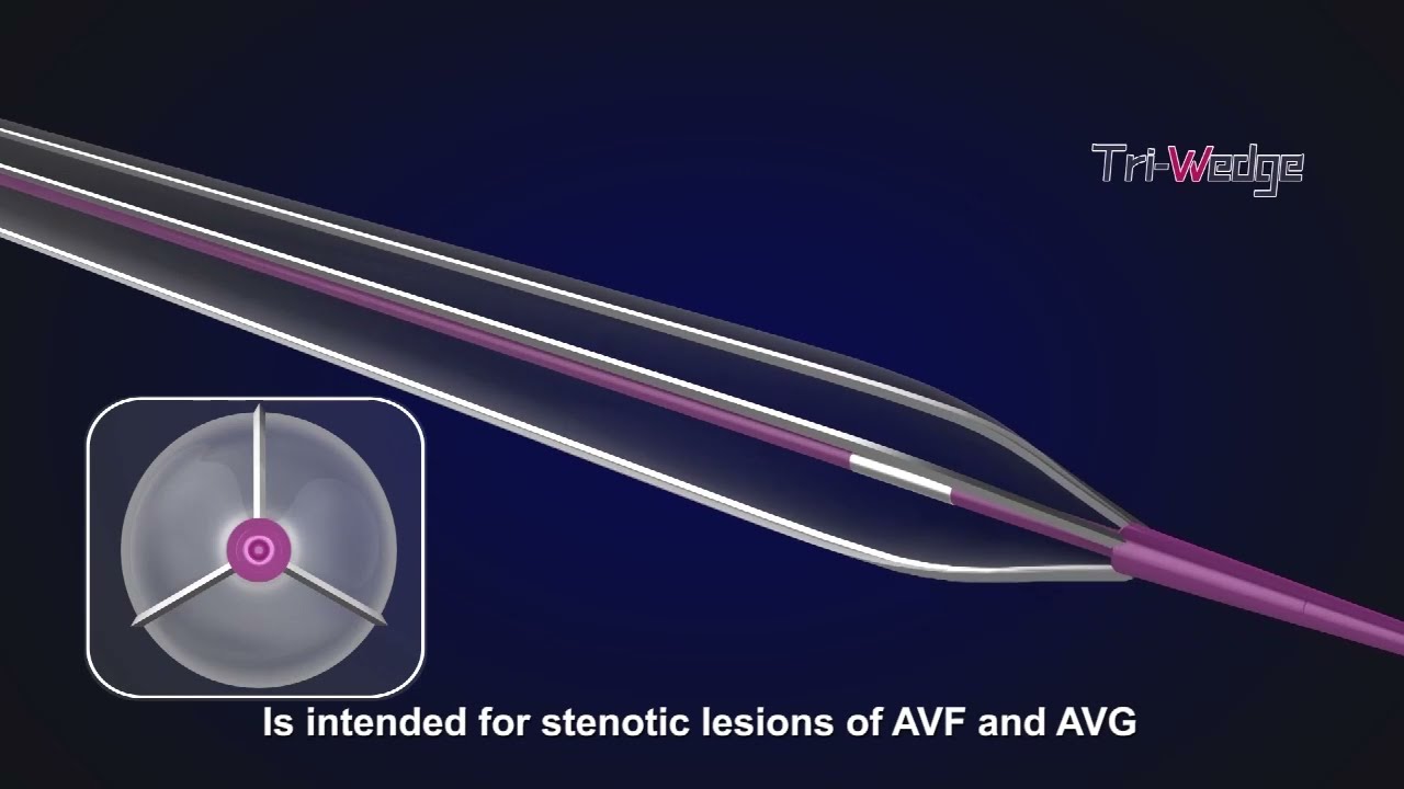 Brosmed Tri-wedge PTA Scoring Balloon Dilatation Catheter