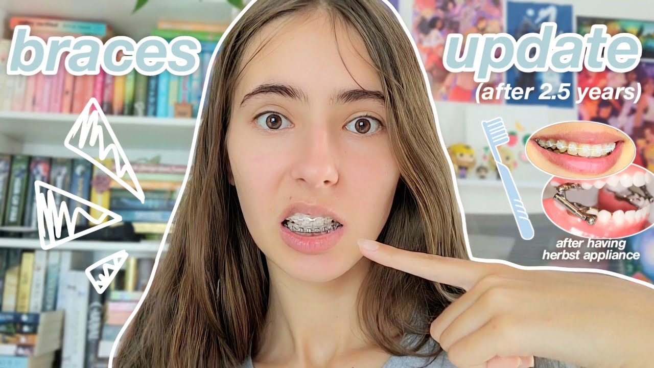 2.5 YEARS BRACES UPDATE 😁🦷✨️ (my journey/experience, dental routine, post herbst appliance)