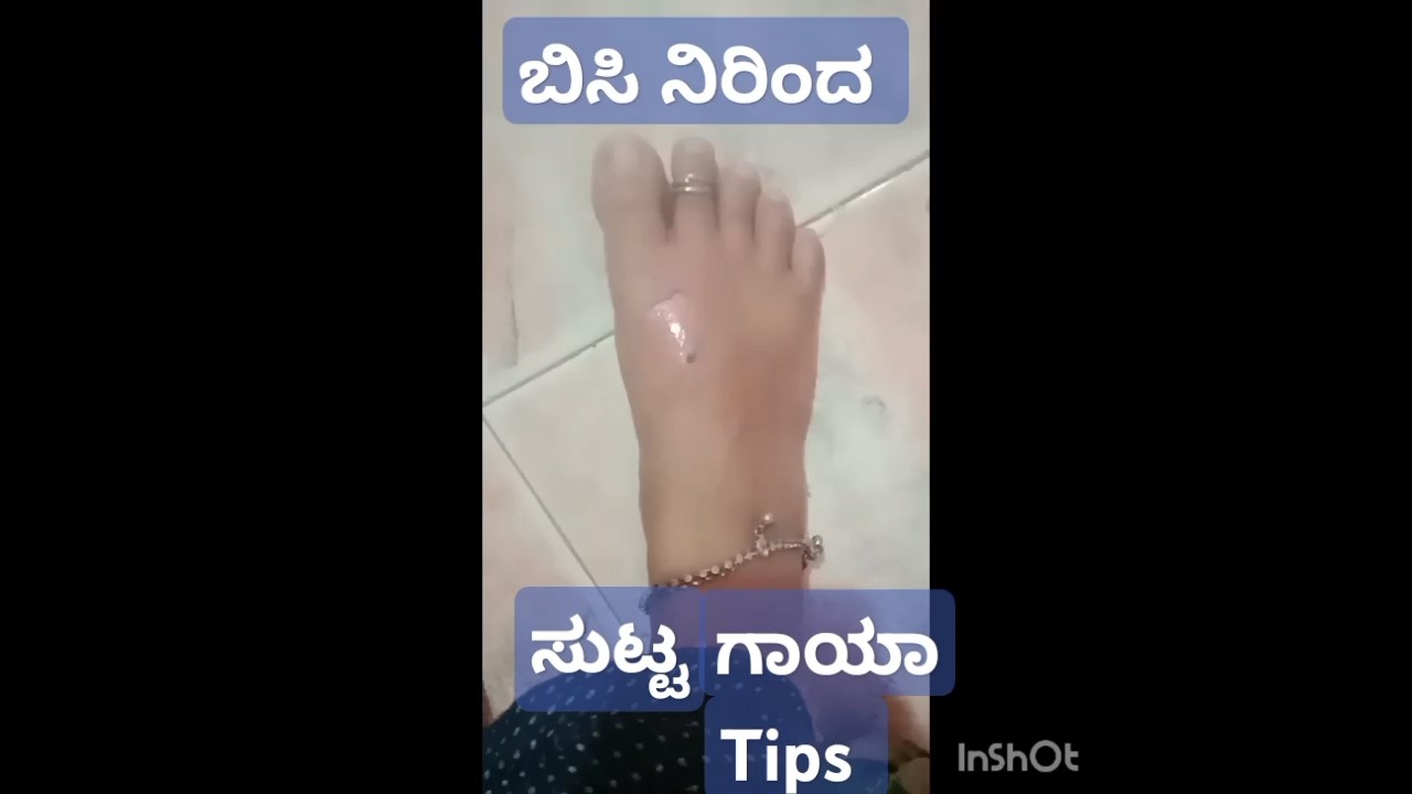 ಸುಟ್ಟ ಗಾಯದ ಉರಿ ತಕ್ಷ್ಣ ಕಡಿಮೆ ಆಗ್ಬೇಕಾ ?# first  Aid for burns#usefultips , pooja Kannada channel 🙏🌺🙏