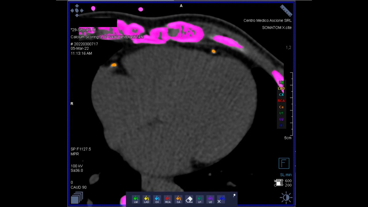 How to perform a cardiac CT scan for TAVI