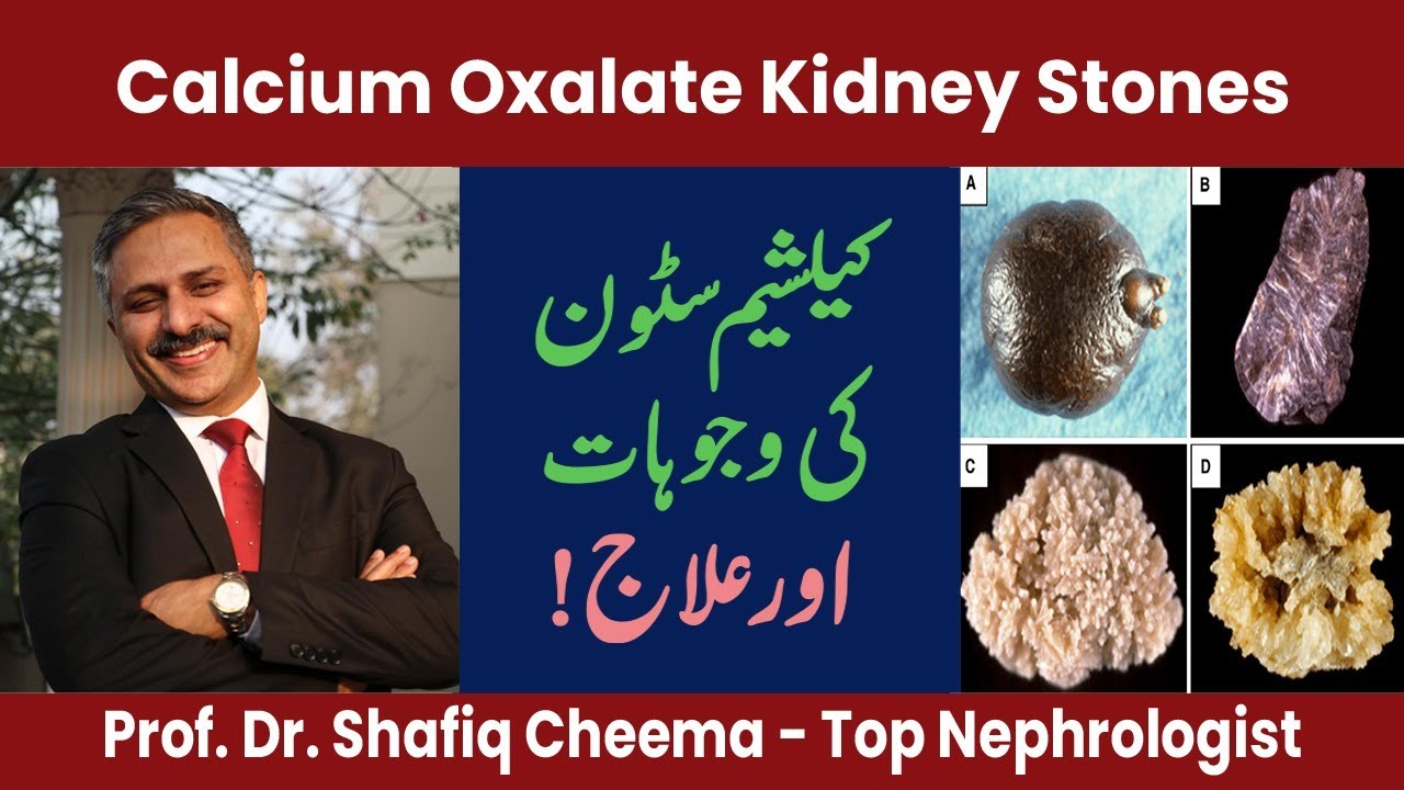 Calcium Oxalate Kidney Stones , Causes & Treatment by The Best Nephrologist in Lahore
