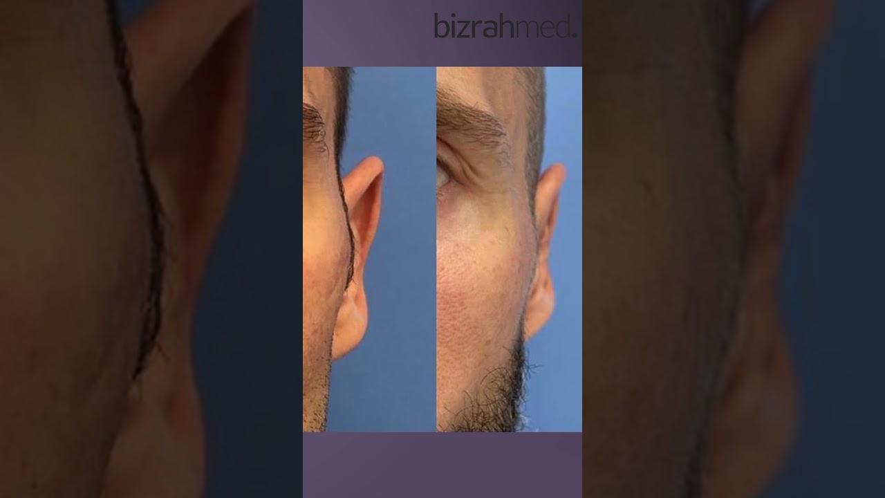 Otoplasty Transformation | Natural Ear Reshaping Results | Bizrahmed Center
