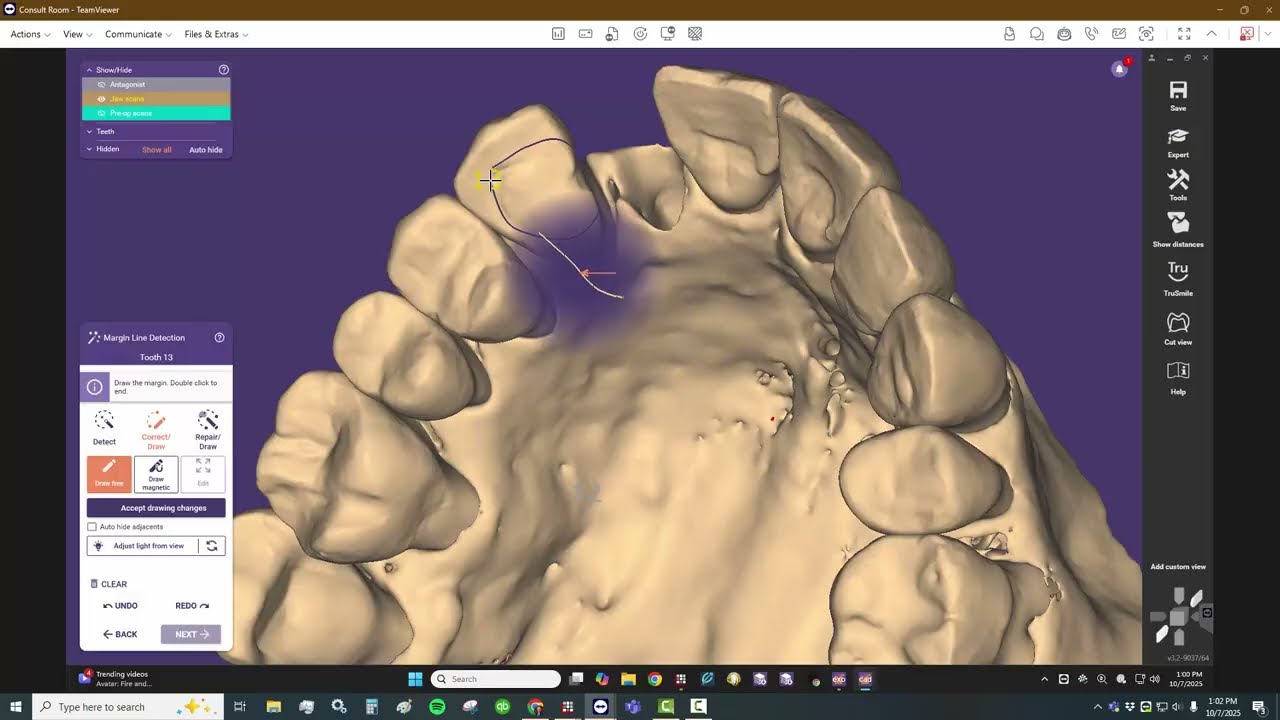 Smilecloud and exocad integration with Resin Bonded Bridge