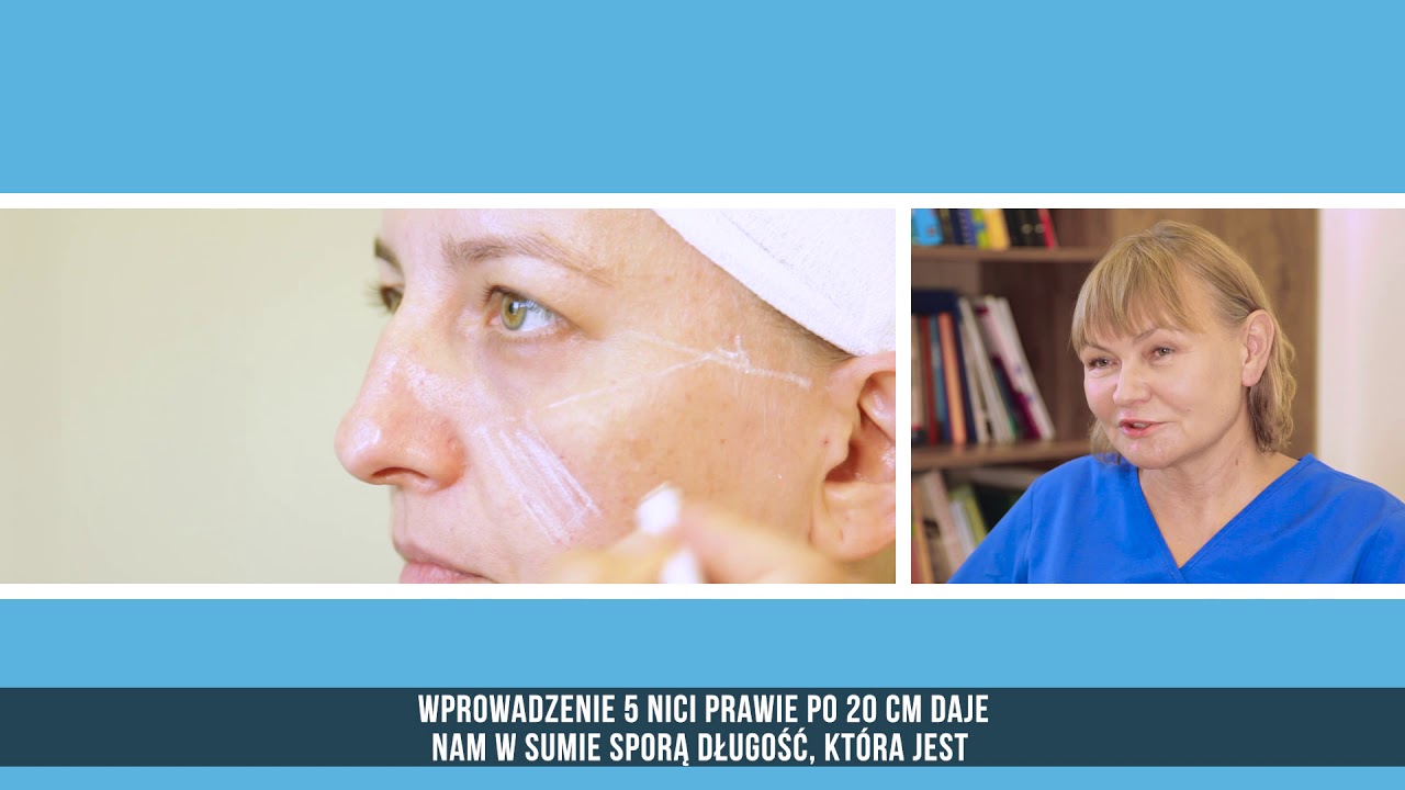 Lifting twarzy z wykorzystaniem nici Aptos z kwasem hialuronowym