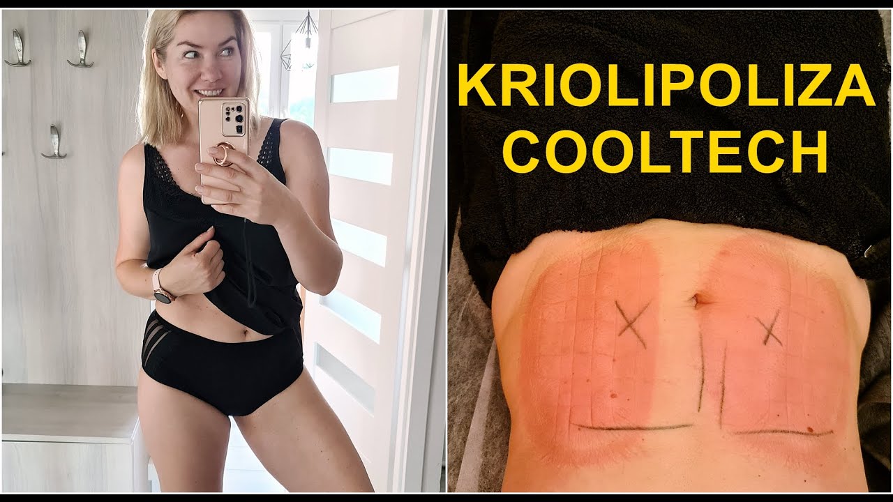 KRIOLIPOLIZA COOLTECH 🔵 EFEKTY I OPINIA 🔵 PRAWIE idealna