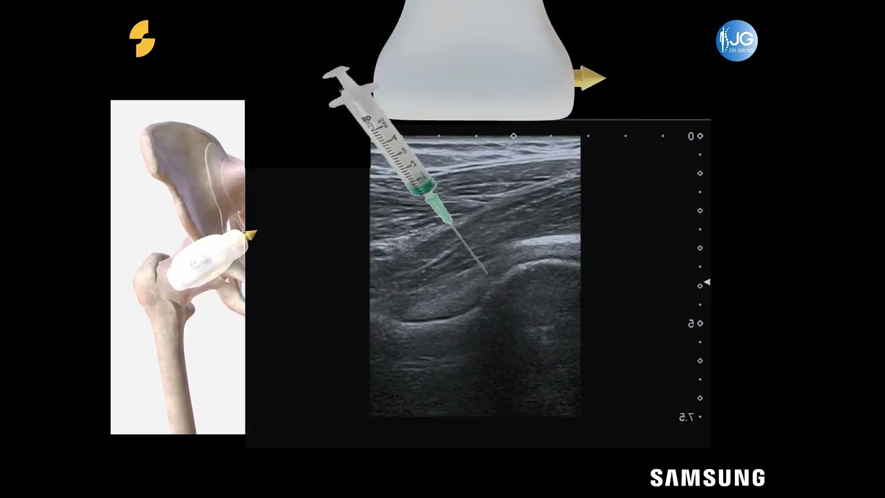Infiltration échoguidée de hanche / Hip ultrasound-guided injection
