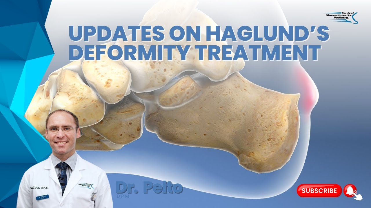 Updates on Haglund's deformity treatment