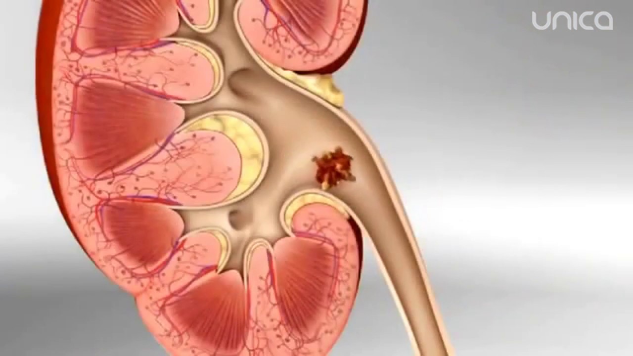 Litotripsia – procedura care te scapă de pietrele la rinichi mai eficient decât ceaiurile diuretice