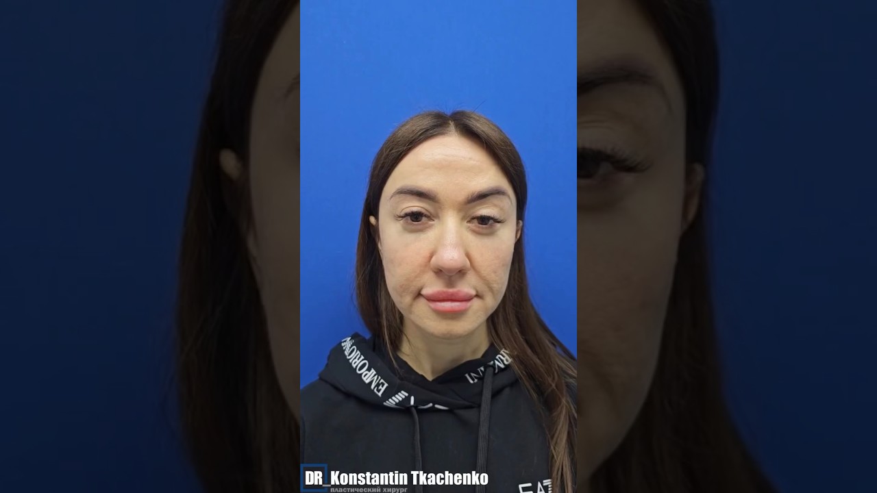 ДЛИТЕЛЬНЫЕ БИОРЕВИТАЛИЗАЦИИ❗️#биоревитализация