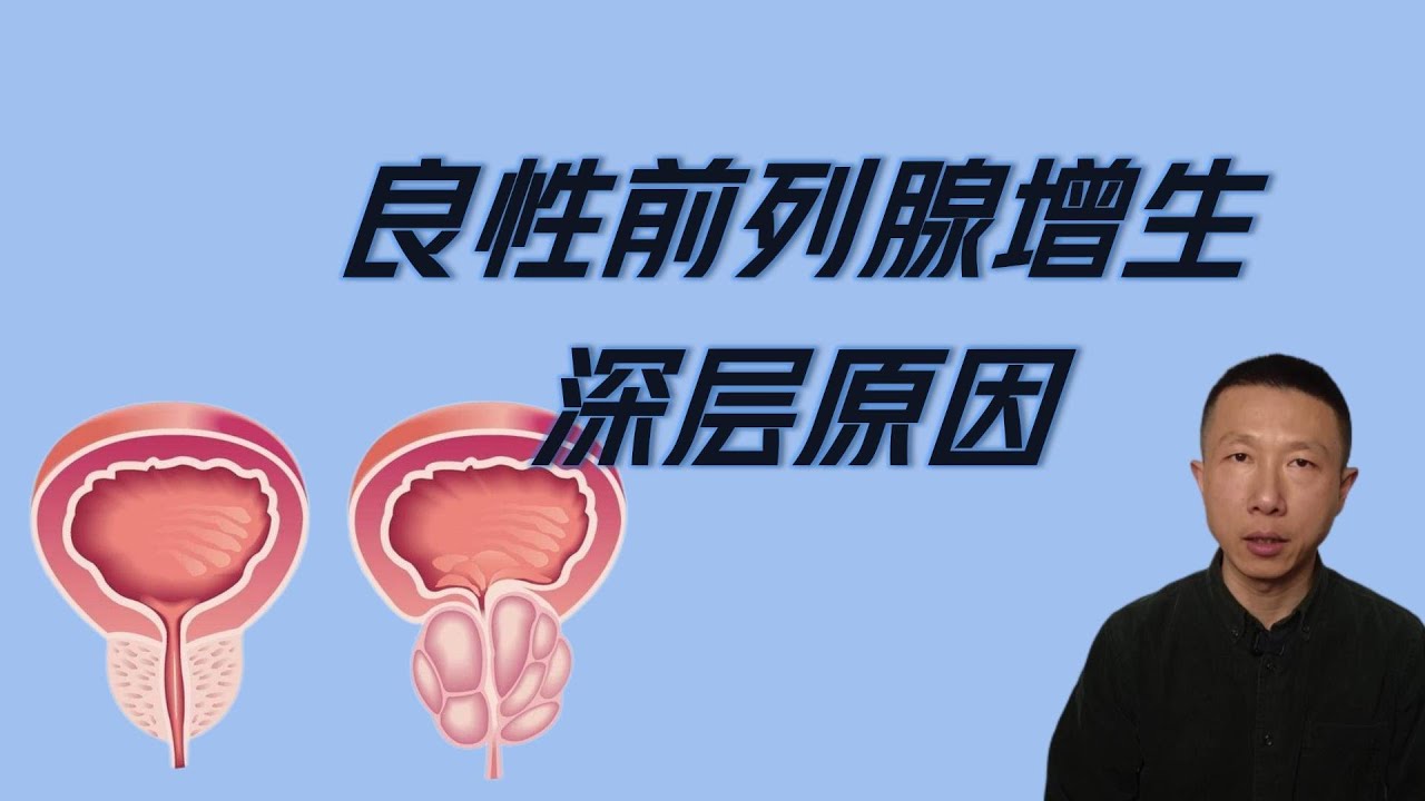 良性前列腺增生的2个深层原因（激素不平衡以及慢性炎症）