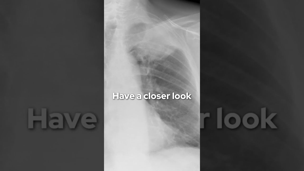 Male in his 60s presents with shoulder pain. What&rsquo;s the diagnosis? #radiology #radiologist #xray