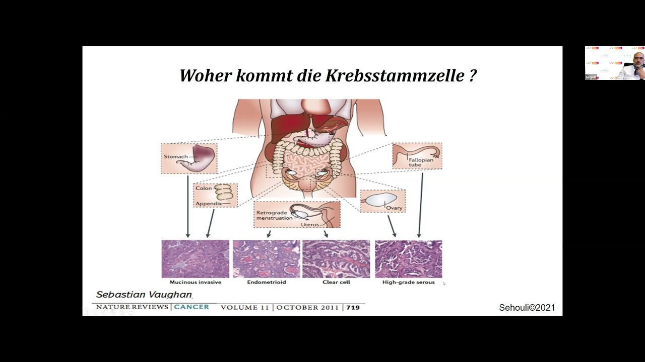 Wie entsteht Eierstockkrebs (BRCAplus Themenreise 1 / 2021)