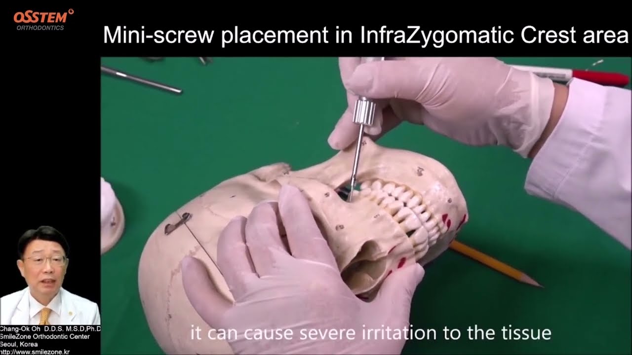 4. IZC_Infrazygomatic Crest (When and How to use 