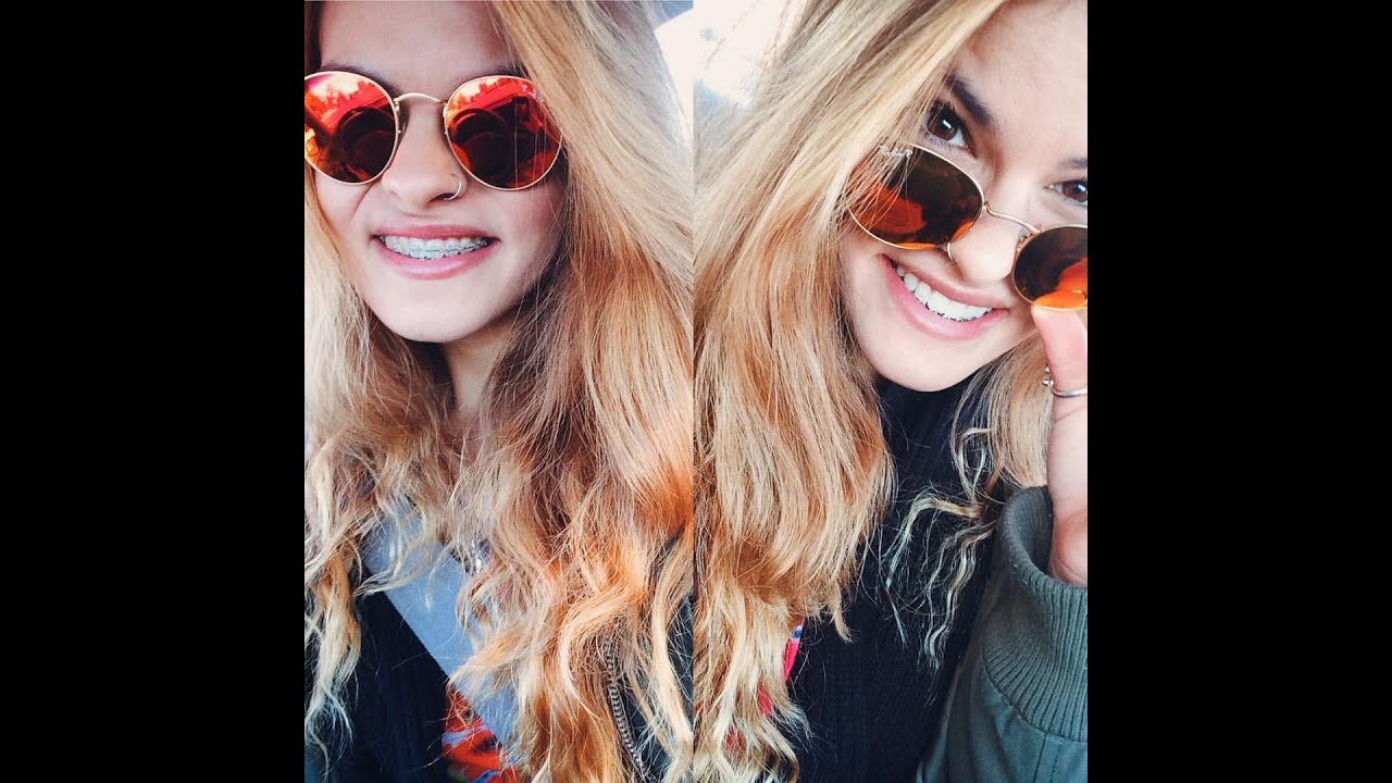 Double Jaw Surgery: Braces off 7 months post op!