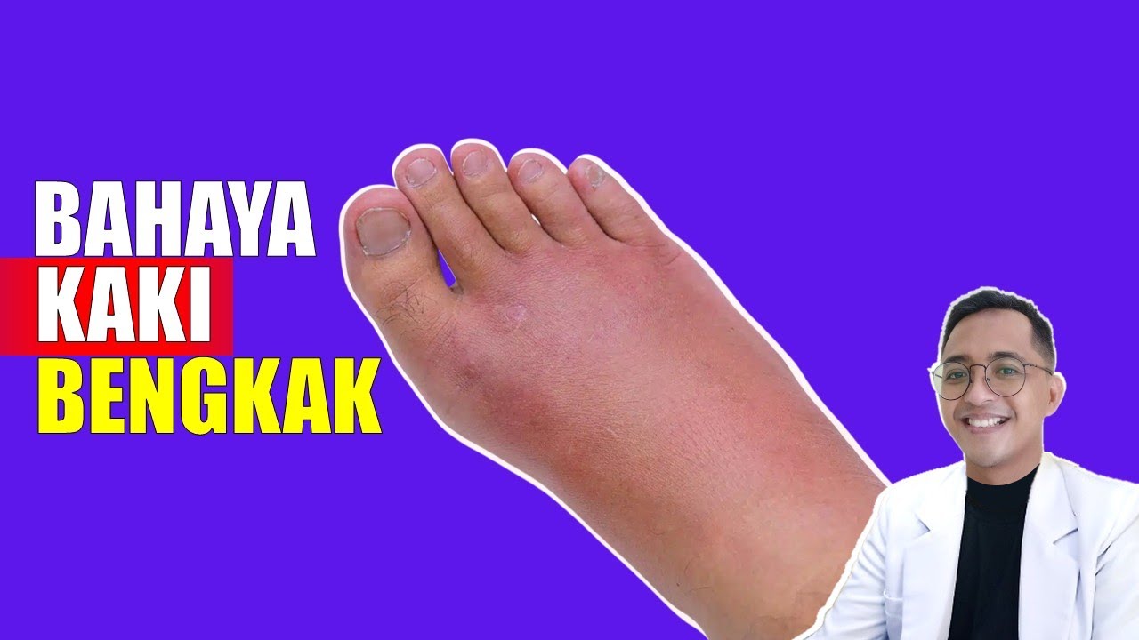 Kaki Bengkak?! Jangan Anggap Sepele – Bisa Jadi Tanda Penyakit Mematikan!
