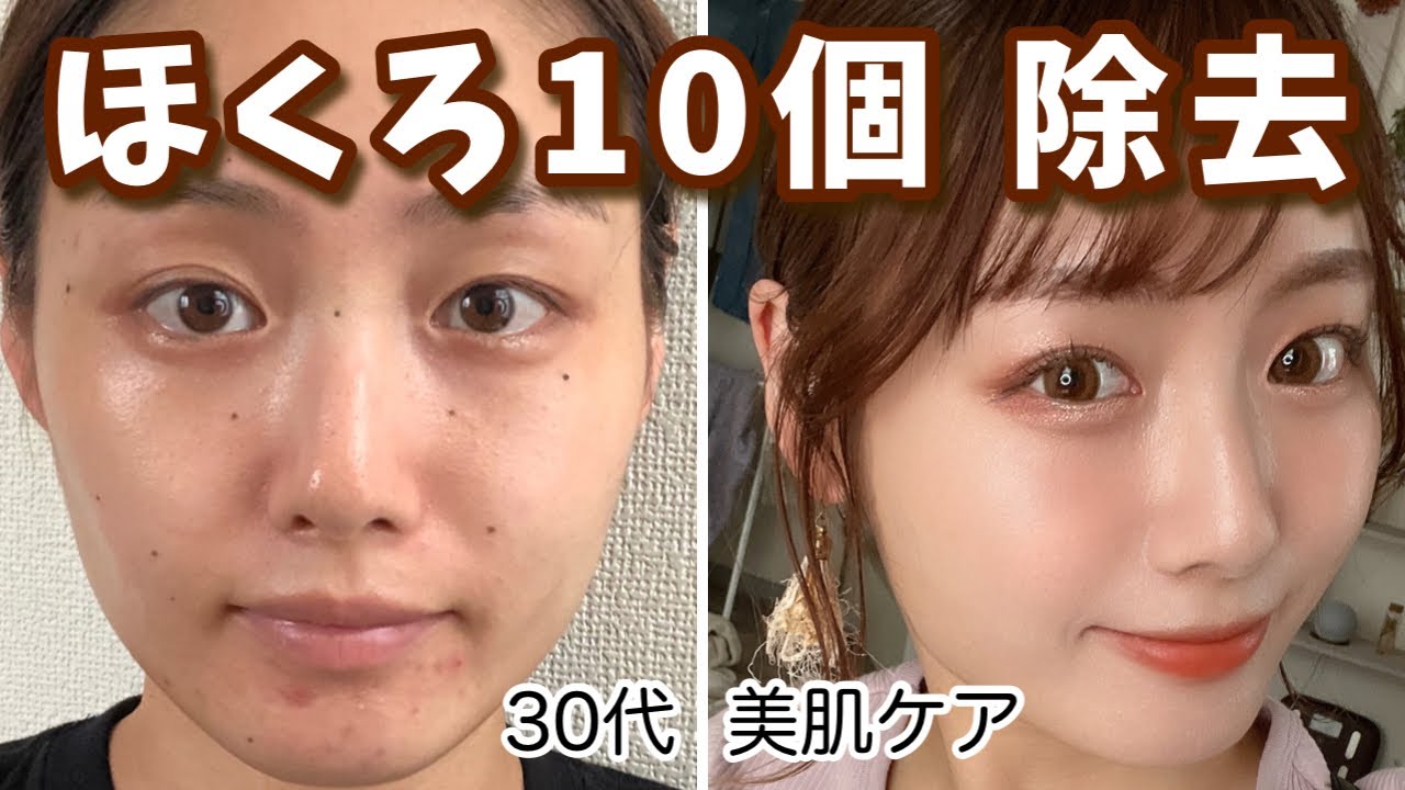 【ほくろ除去】レーザー除去して1年半｜傷跡は？完全完成？アラサー美容【CO2レーザー】