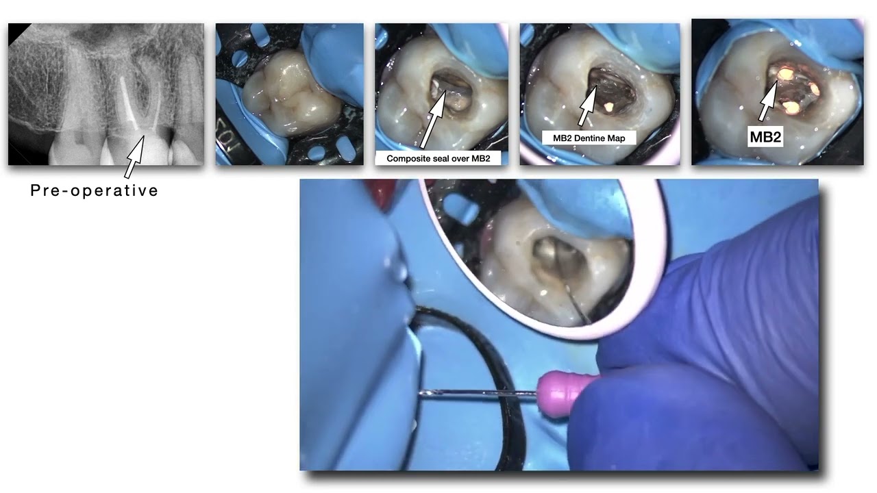 Introduction to Dental Operating Microscope (DOM)