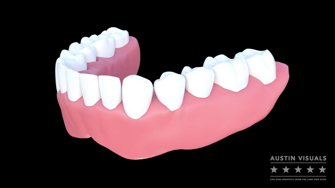 Genius implant abutment. Austin Visuals