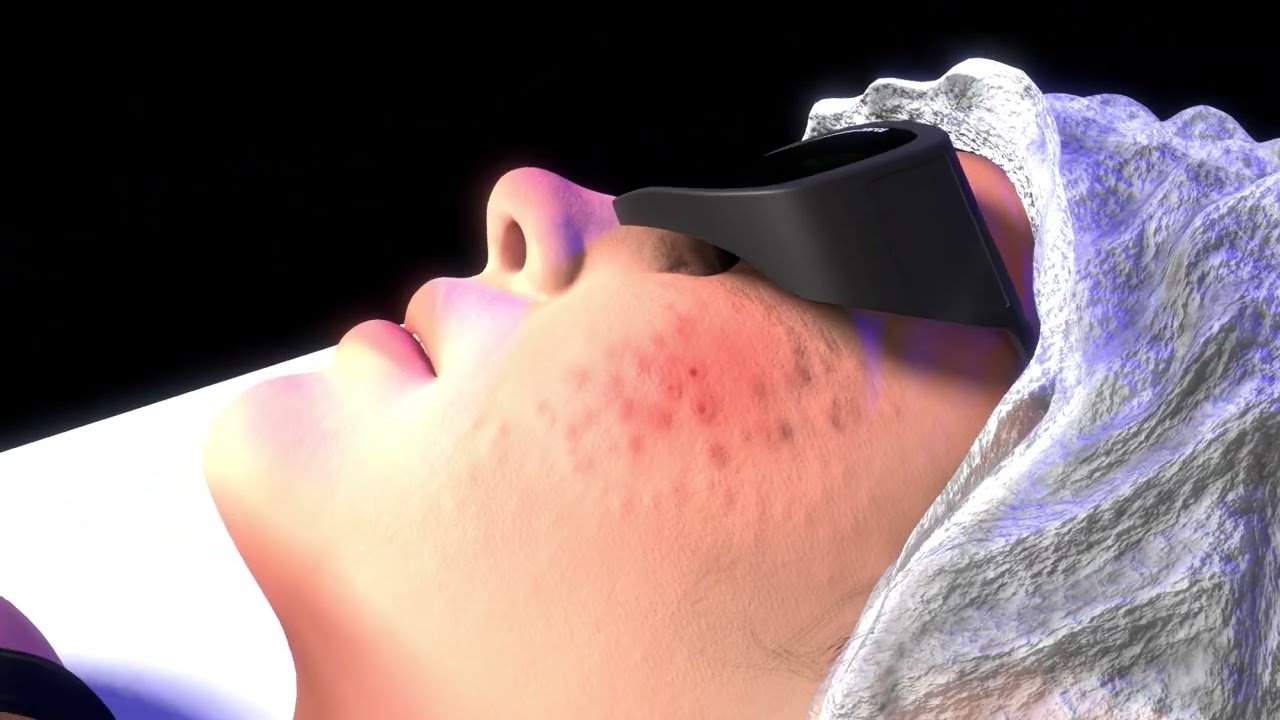 Máquina ipl profesional IP-100