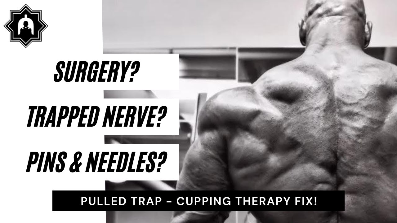 BODYBUILDER with TRAPPED NERVES recovers using CUPPING & SCRAPING!