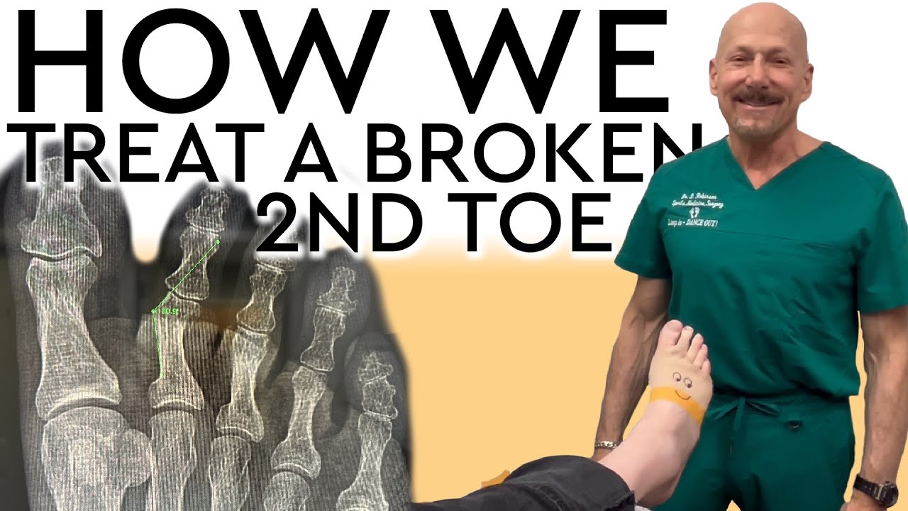 How We Treat A Broken 2nd Toe
