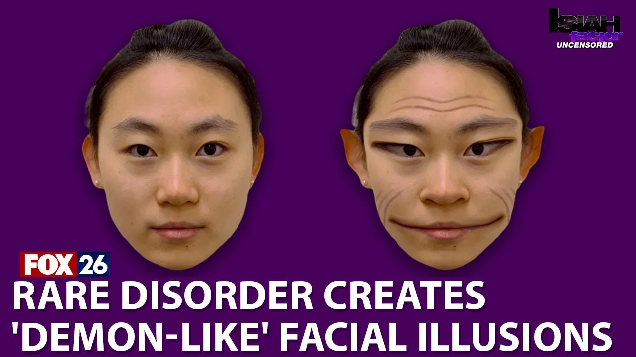 Rare 'demon face' syndrome