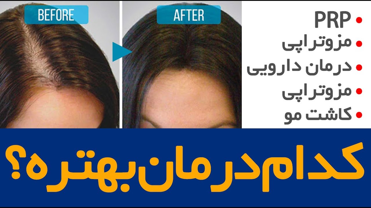 بهترین درمان های ریزش مو کدام است؟