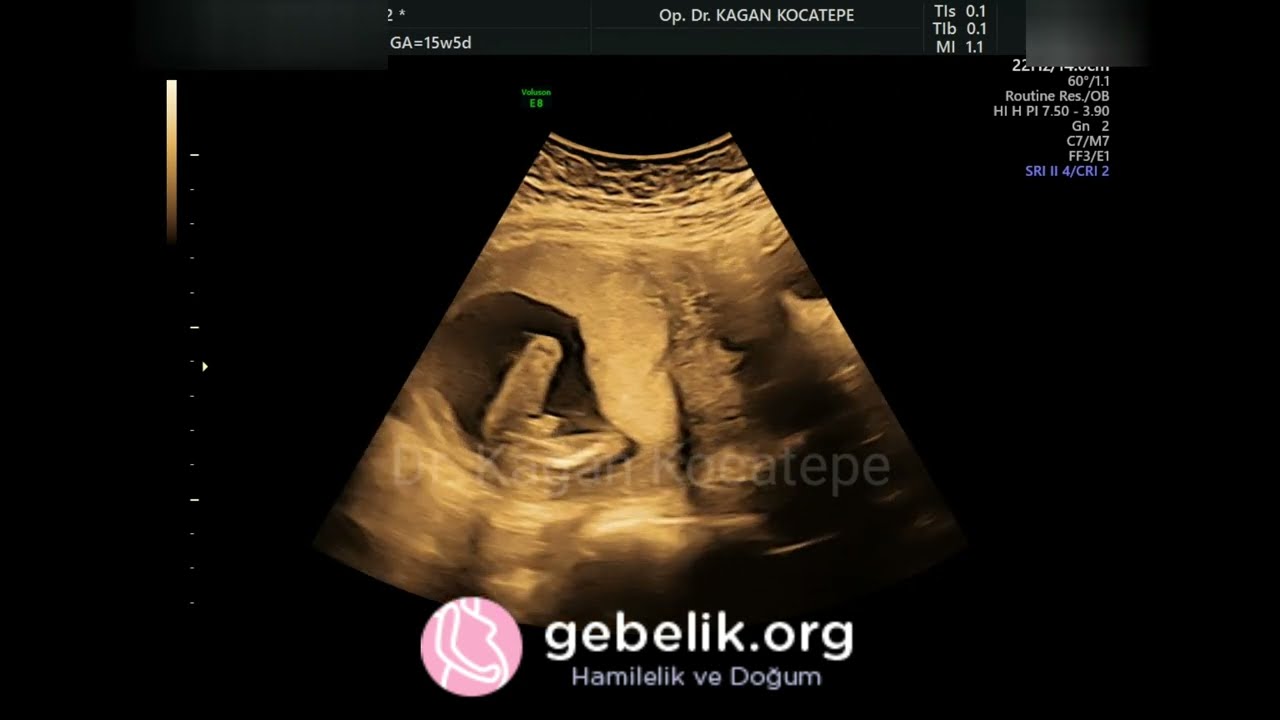 15+5 weeks (3.5 months) boy fetus. Genital organ seen looking at the area between legs, from below.