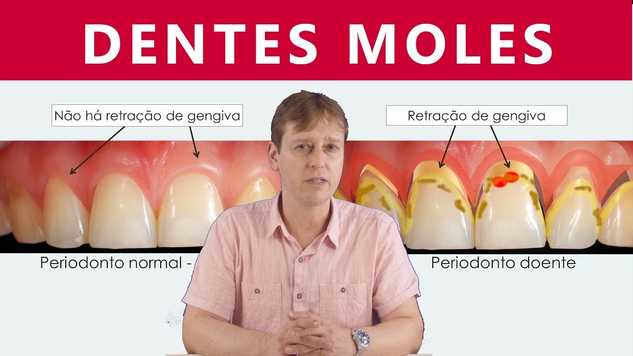 Dentes Moles  - Mobilidade do Dente sem Periodontite ou Retração de Gengiva