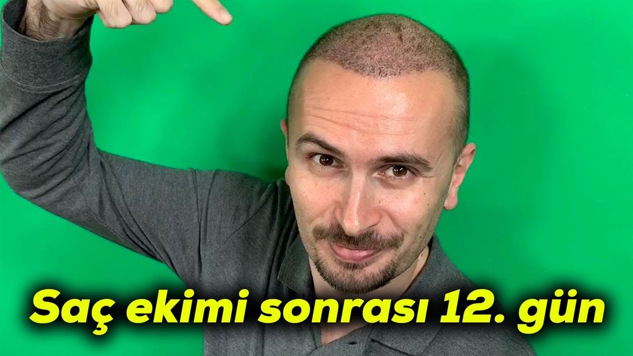 Saç ekimi sonrası 12. gün | Ekilenler uzuyor