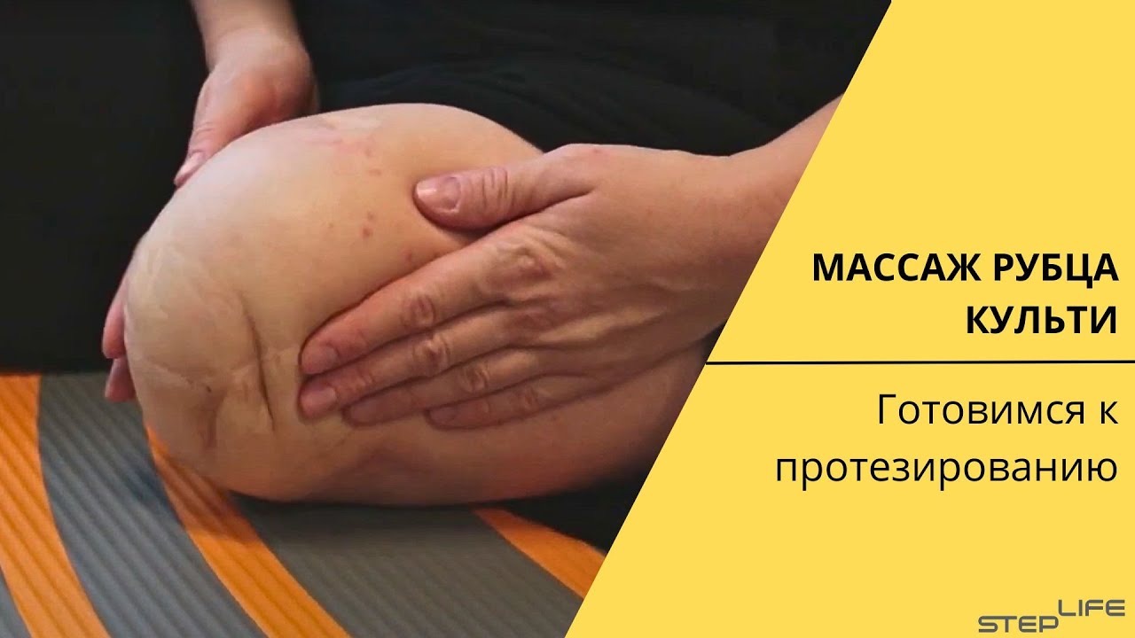 Массаж рубца культи | Школа ходьбы STEPLIFE