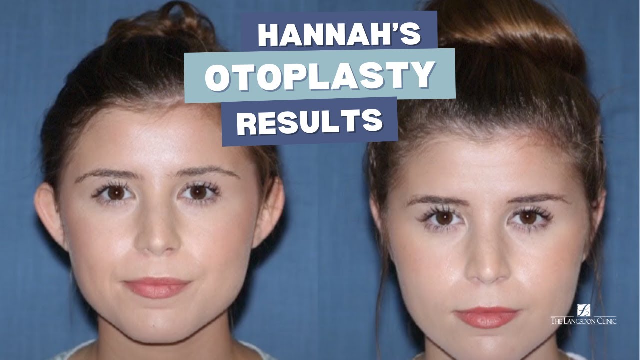 My Otoplasty Experience Changed My Life Forever