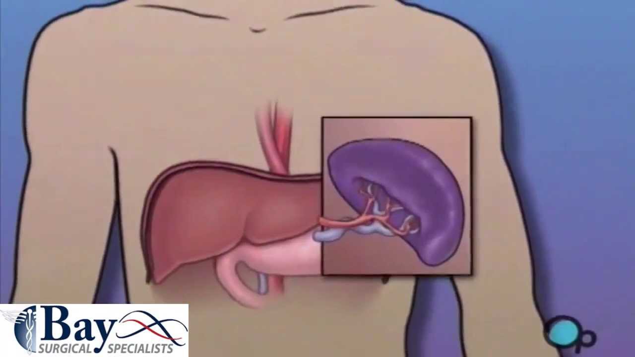 Splenectomy - Surgical Removal of the Spleen