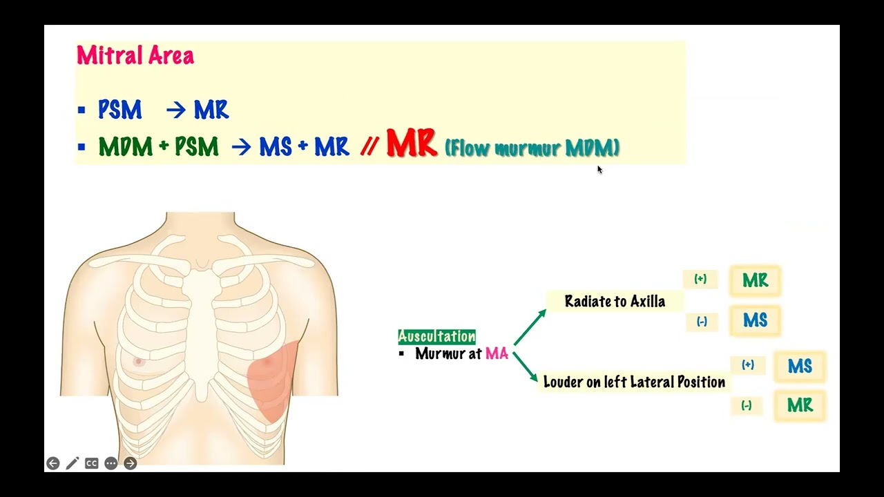 DDx of MDM