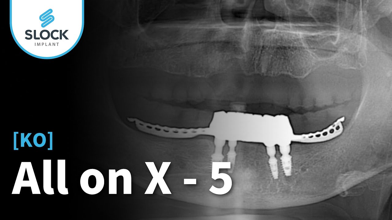 [KR] AllonX - 5
