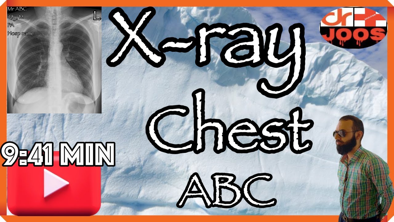 Video 1/ ABC of chest x-ray/ Xray Made easy/  The easiest way to understand - dr joos