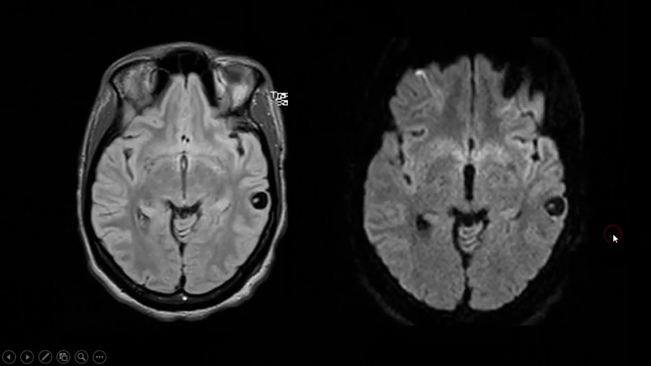Neurocisticercose