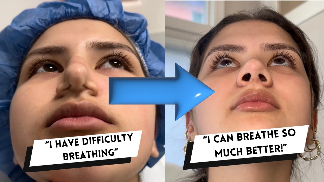 Nasal Valve Collapse NYC