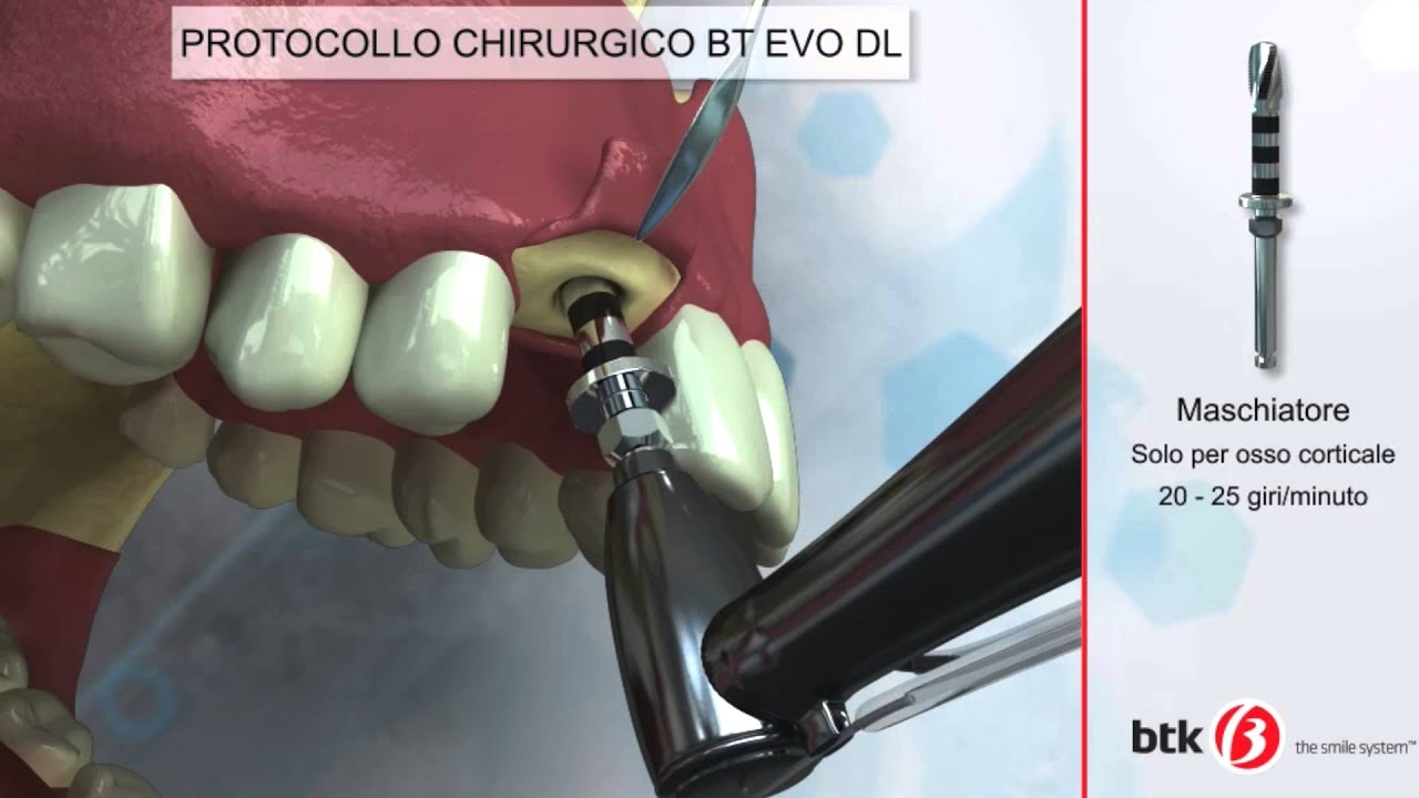 Inserimenti Impianto Endosseo Osteointegrato Arcata Superiore - Visione 3D