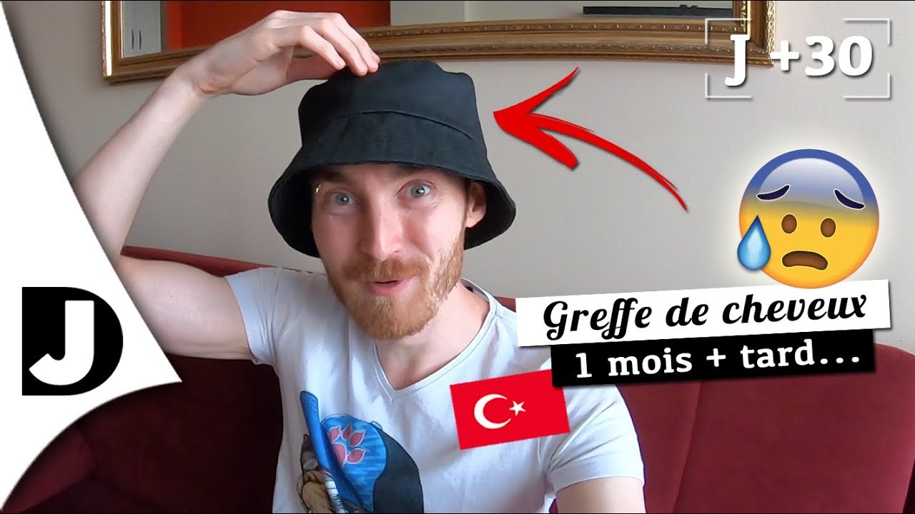 🇹🇷 [GREFFE de CHEVEUX J+30] Bouton, rougeurs et perte de cheveux ! 😢