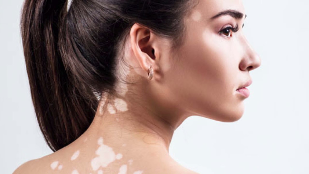 Vitiligo Nedir ? Belirtileri Neler ? Nasıl Tedavi Edilir ? Yapılması Gerekenler