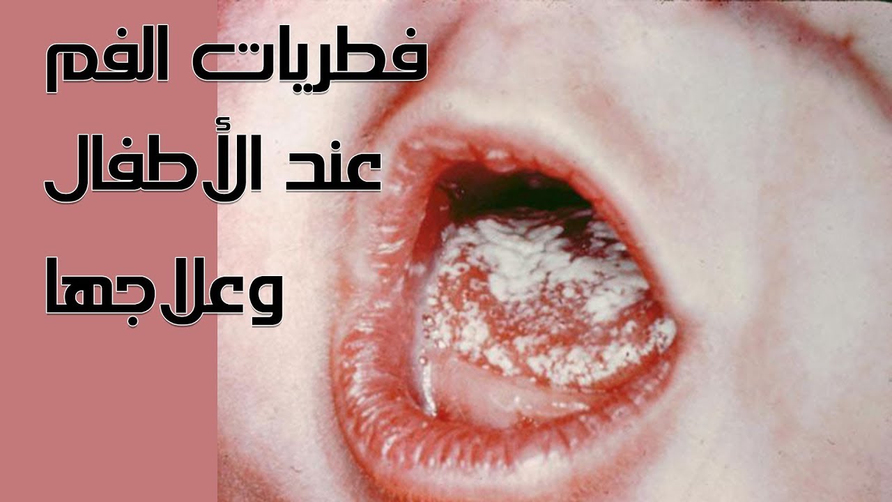 طريقة ازالة فطريات الفم عند الاطفال