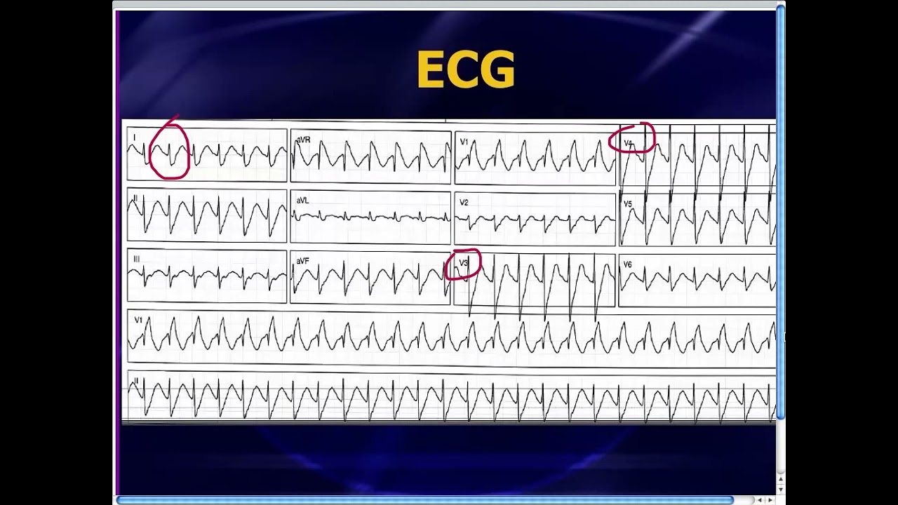 Amal Mattu's ECG Case of the Week_ May 12, 2014