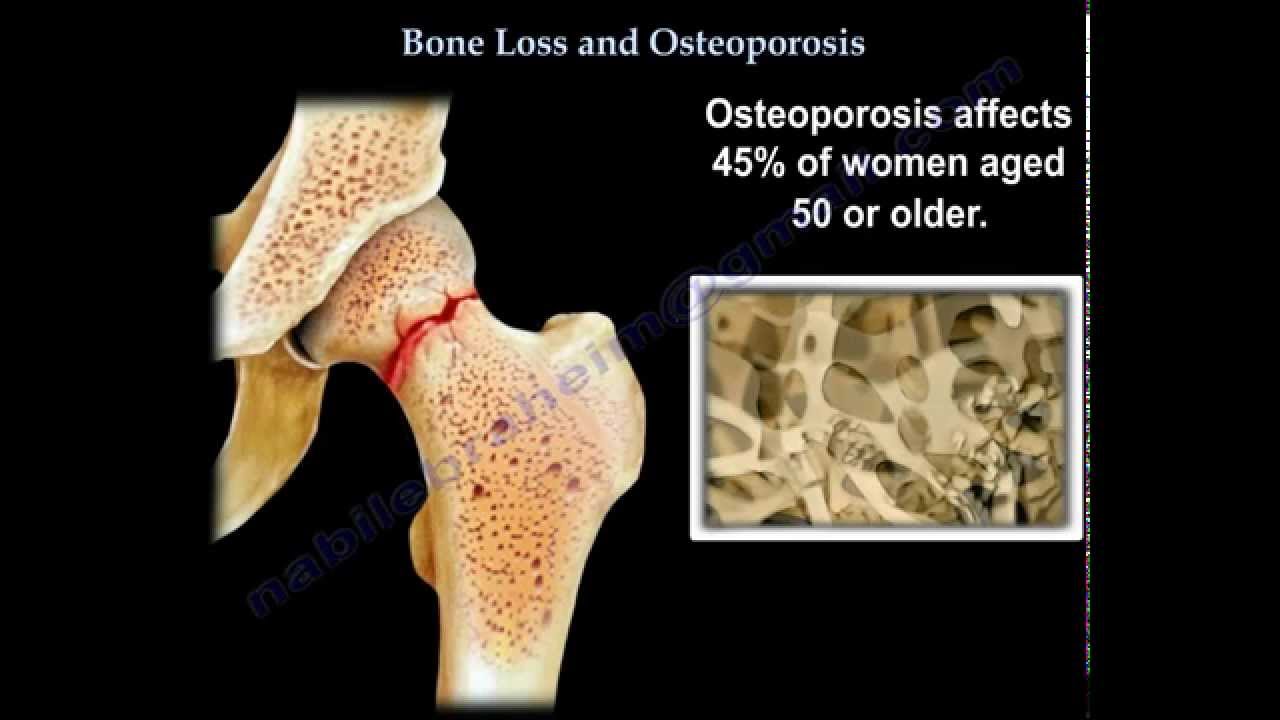 Osteoporosis - Everything You Need To Know - Dr. Nabil Ebraheim