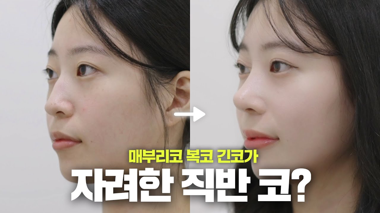 순수 우유에 자려한 직반코 한 스푼 | 코성형 브이로그