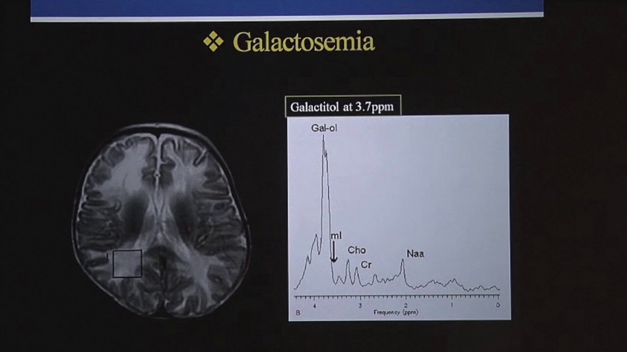 TMT: Pediatric White Matter Diseases - Part III by Dr Deepak Patkar