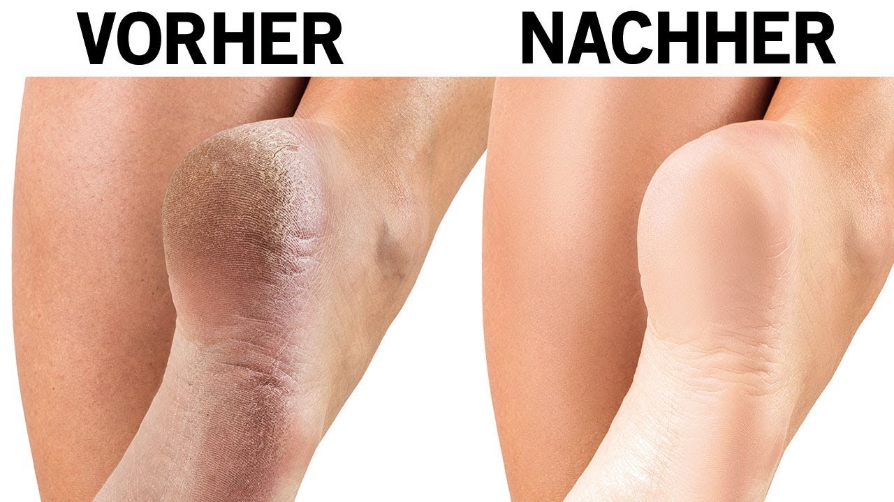 So behandelst du rissige Fersen mit einfachen Hausmitteln!